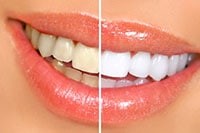 Cosmetic Dentistry - Teeth Whitening